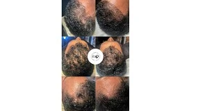 Foto de La mesoterapia capilar: el nuevo 'hair boost' sin bisturí, el secreto mejor guardado para lucir una melena densa y saludable