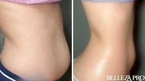 Foto de Volnewmer RF: la radiofrecuencia monopolar que redefine la firmeza facial y corporal