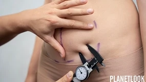 Foto de Yvette Pons explica cómo prevenir y tratar la fibrosis postoperatoria abdominal