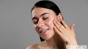 Foto de El acné en adultos aumenta por los cambios en el estilo de vida, según los expertos
