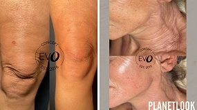 Foto de ¿Hay que esperar a septiembre para hacerse un tratamiento de medicina estética?