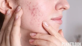 Foto de Acné en la menopausia: por qué aparece y cómo adaptar el cuidado de la piel adulta