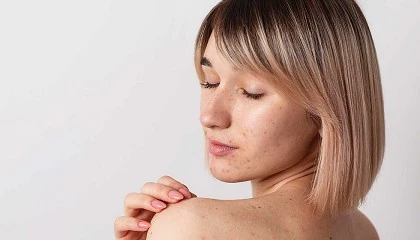 Foto de Rutina de Dermalogica para eliminar el acné corporal