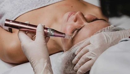 Foto de Protocolo de tratamiento para tratar las manchas a travs del microneedling