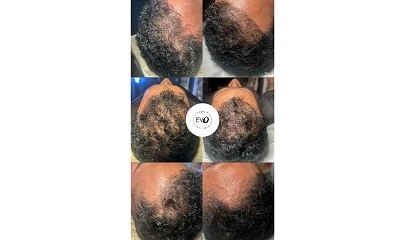 Foto de La mesoterapia capilar: el nuevo 'hair boost' sin bisturí, el secreto mejor guardado para lucir una melena densa y saludable