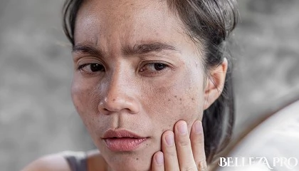 Foto de Cmo prevenir y tratar las manchas tras el verano: consejos expertos de la Dra. Beatriz Beltrn
