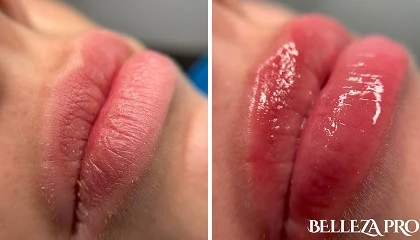 Foto de Tratamientos de labios que triunfan a todas las edades