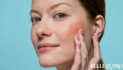 Foto de Cmo eliminar las cicatrices del acn: los tratamientos ms eficaces segn la Dra. Beatriz Beltrn