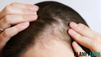 Foto de Hospital Capilar alerta: el injerto capilar no �cura� la alopecia sin tratamiento m�dico