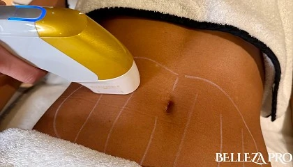 Foto de Empezar hoy es la clave para optimizar los resultados de los tratamientos corporales de cara al verano