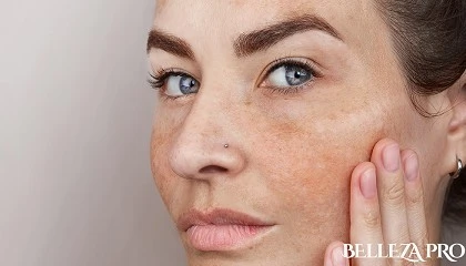 Foto de Cómo prevenir y tratar las manchas en la piel con la llegada de la primavera