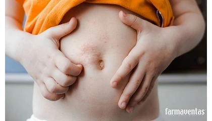 Foto de Afecciones cut�neas m�s comunes de la infancia en verano