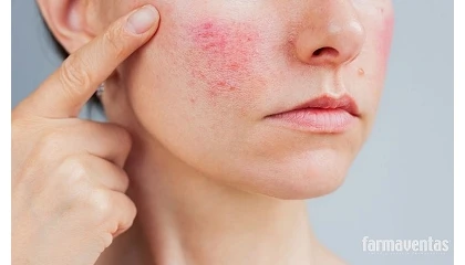 Foto de Piel alterada en la farmacia: abordaje profesional en el mostrador de cuperosis, ros�cea e irritaciones de la piel