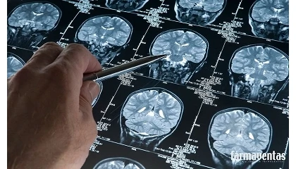 Foto de La Medicina de Precisi�n avanza hacia el diagn�stico biol�gico del Alzheimer