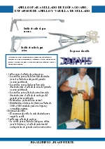 Anillos para sellado de esofago