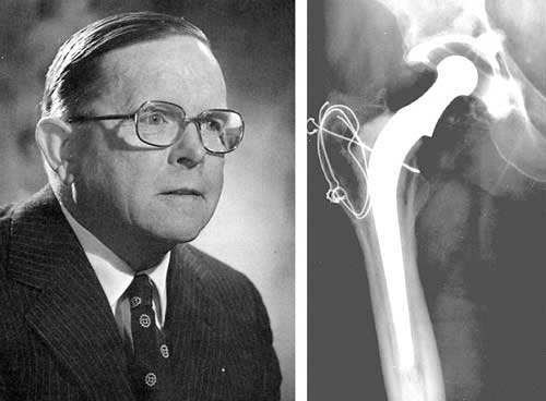 Figura 2: A la izq., Sir John Charnley. A la dcha: podemos ver su prtesis metal-polietileno implantada