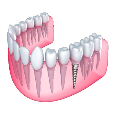 Figura 1. Implante dental en mandbula inferior [2]