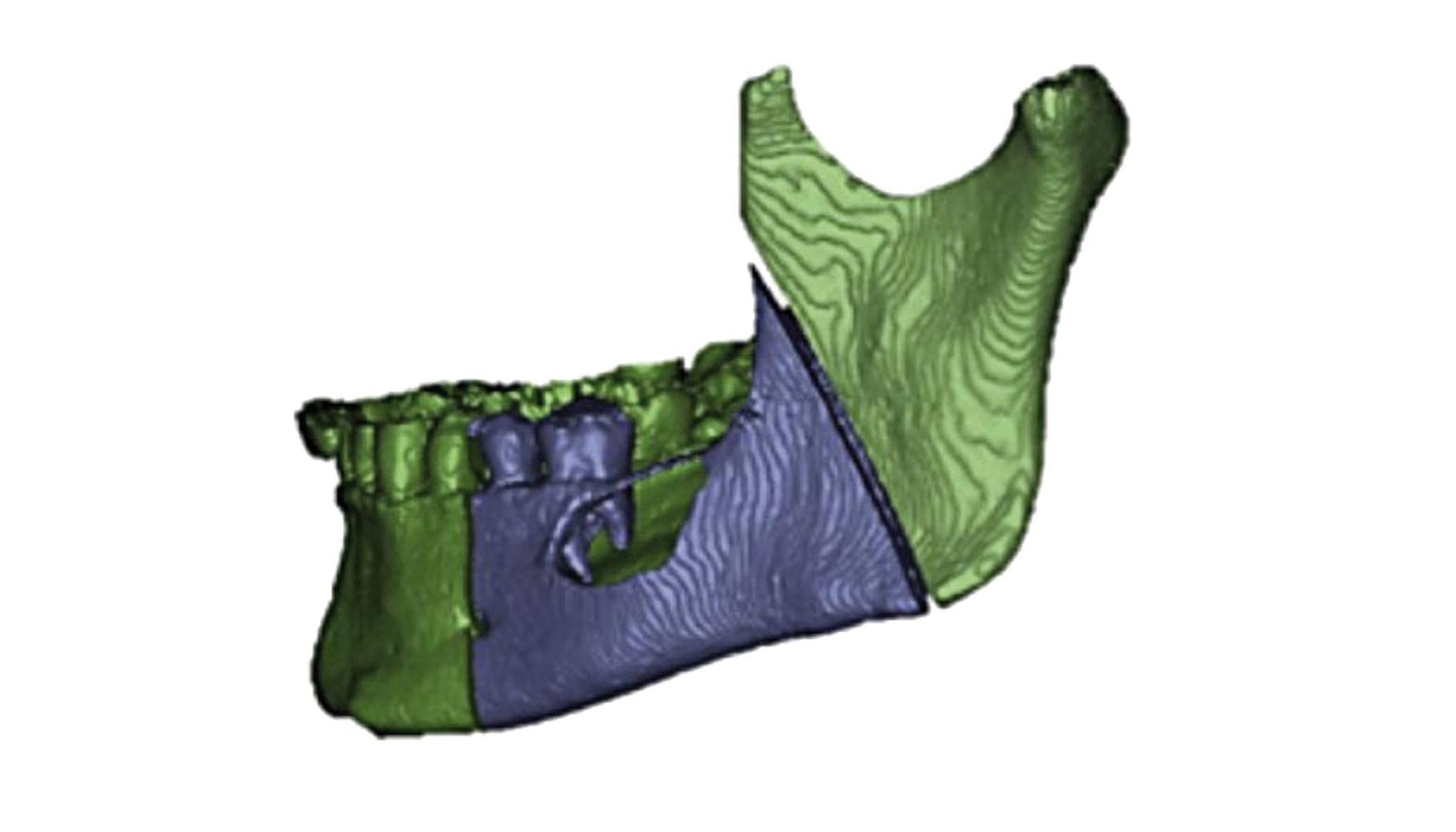 Mandbula en 3D. Journal of Cranio-Maxillo-Facial Surgery