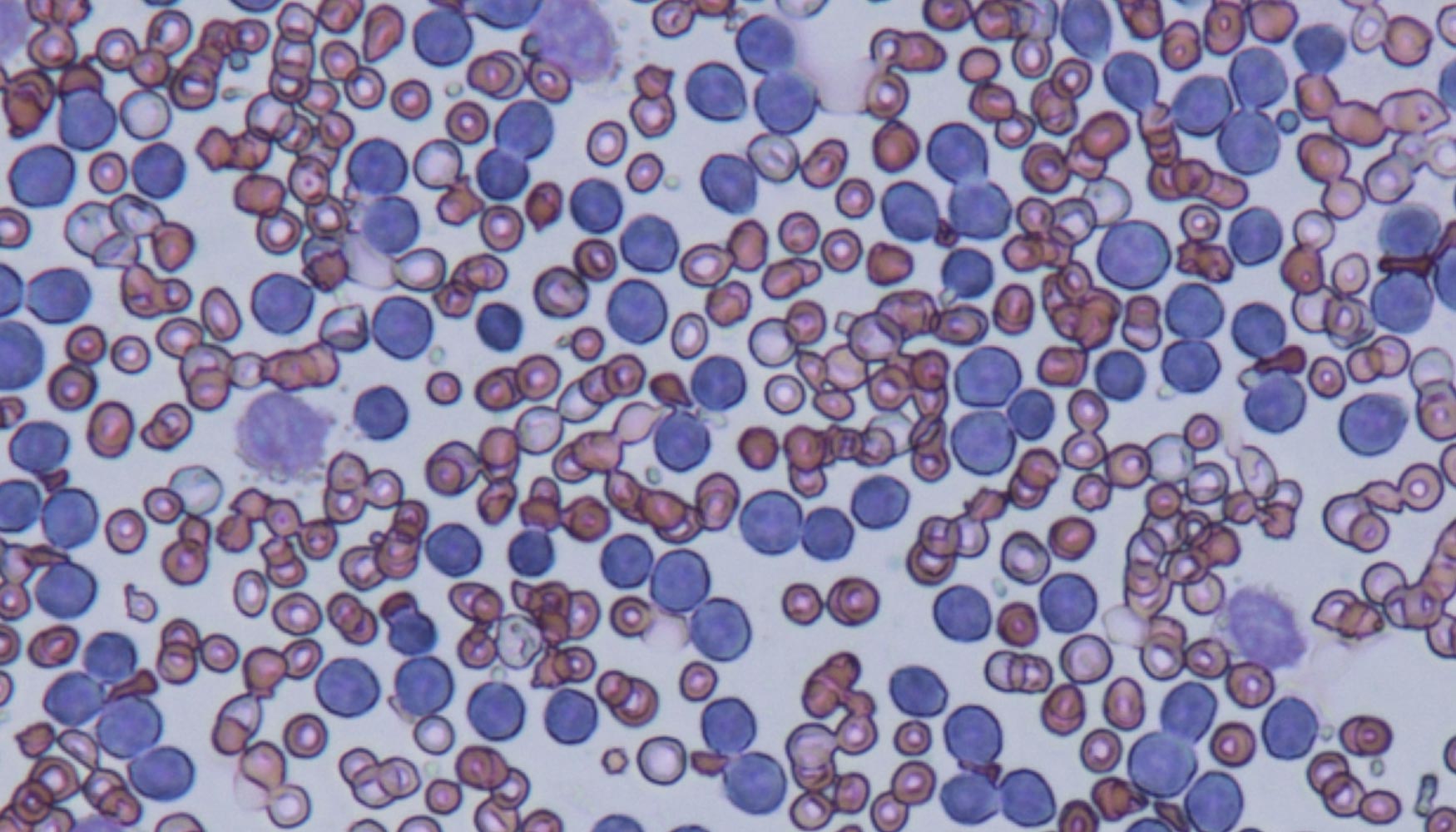 Imagen microscpica de un frotis de leucemia