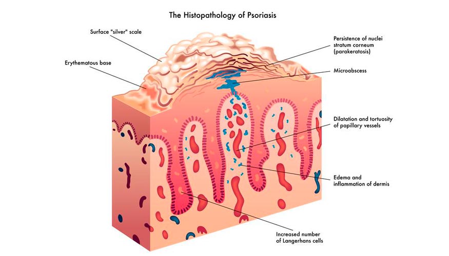 La histopatologa de la psoriasis