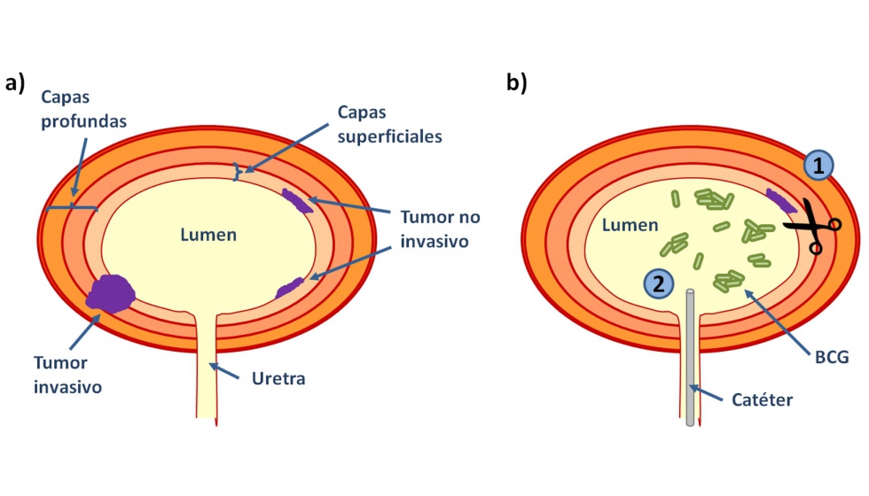 Figura 1. Representacin esquemtica de los estadios de los tumores de vejiga y del tratamiento del cncer superficial...