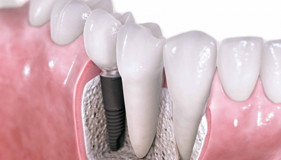 Una nueva tecnología mejora los recubrimientos de implantes dentales -  Metalmecánica