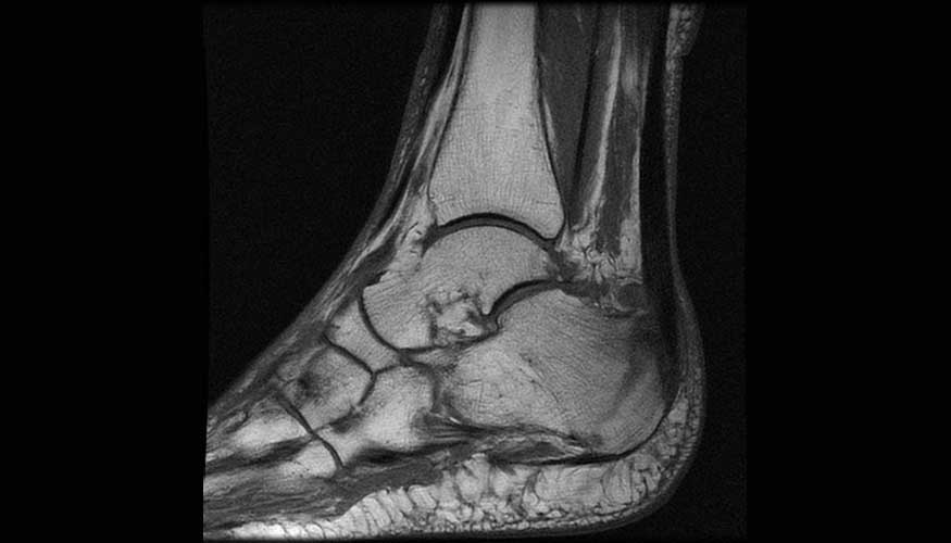 Radiografa de fractura en un pie. Foto: F.Descubre