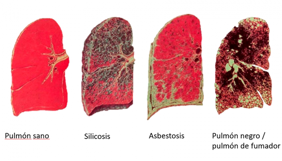 Imgenes de pulmones: sano (izq.) y afectado por diversas patologas