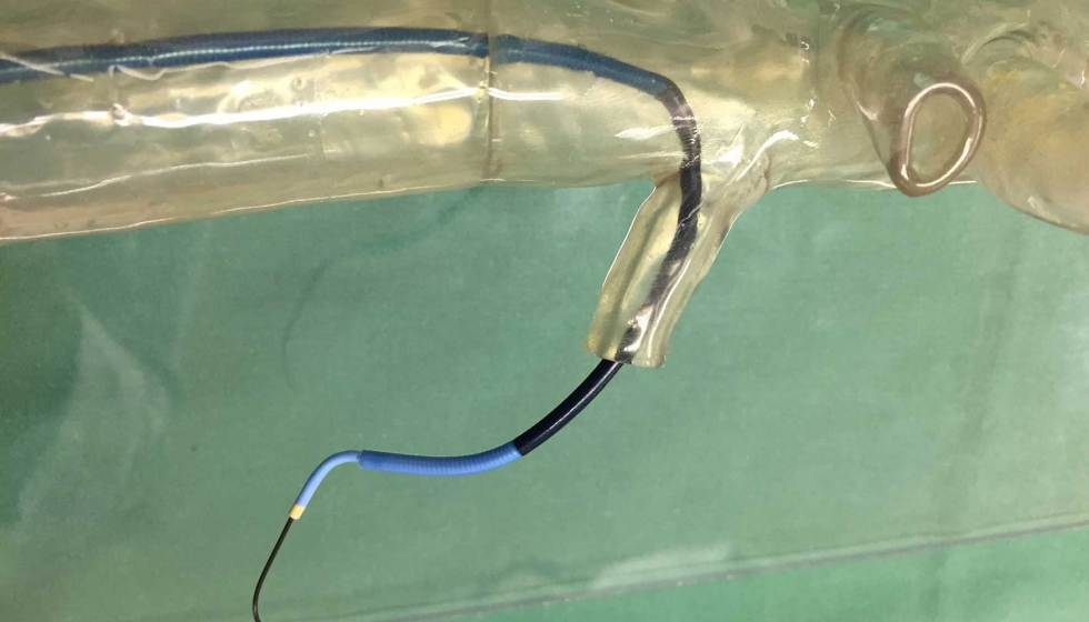 Los cirujanos utilizan un modelo impreso en 3D transparente y de alta precisin para desarrollar el implante complejo de un stent a travs de las...