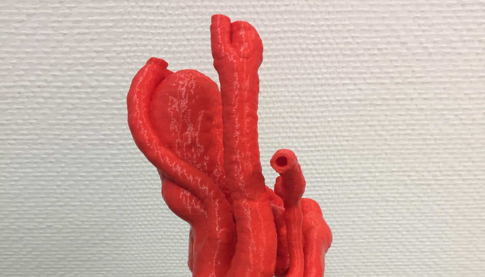 Mediante la impresin en 3D de un modelo del vaso sanguneo del paciente en el que es necesario colocar el stent...