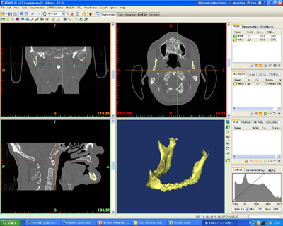 Figura 3: Tomografa Computerizada de la Mandbula