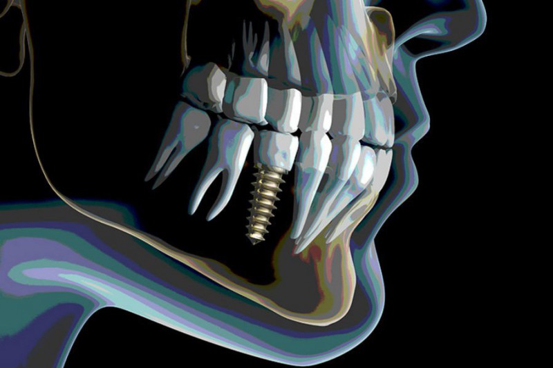 Almacn automtico de VRC para las piezas dentales de Mozo-Grau