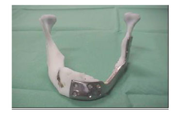 Figure 6: El implante mandibular con material ABS