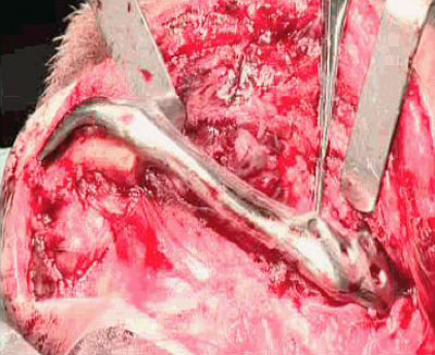 Figure 7: La operacin de implante mandibular