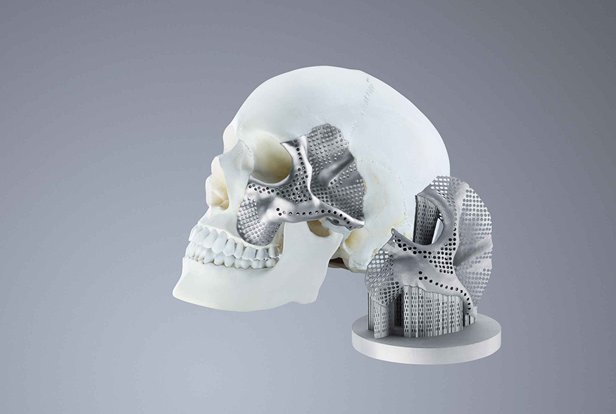 O fabricante de dispositivos mdicos CONMET utiliza uma impressora 3D da Trumpf para produzir implantes crnio-maxilo-faciais...