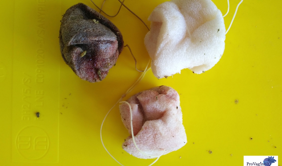 Diferentes grados de coloraci�n en esponjas vaginales tras ser extra�das. Algunas con secreciones y olores anormales, indicativo de vaginosis...
