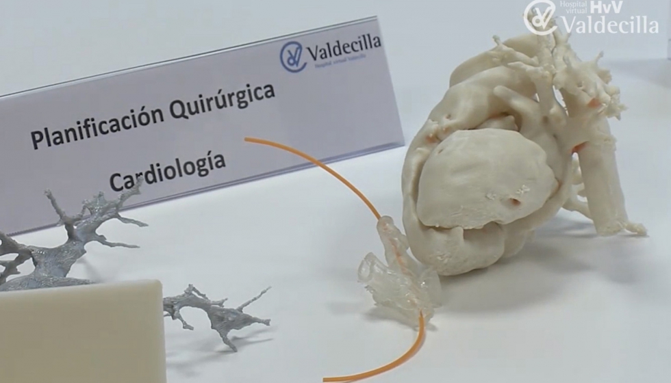 Hospital virtual de Valdecilla. Impresiones 3D para planificacin quirrgica