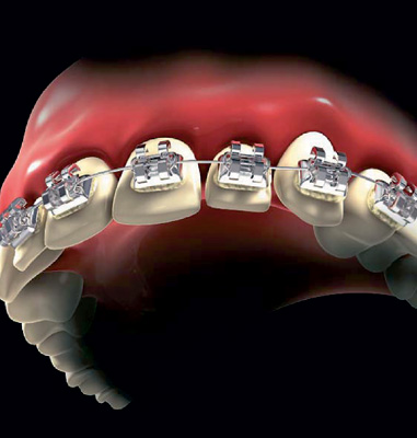 Estos materiales en los brackets de ortodoncia permiten que el esfuerzo que realizan sea constante a pesar de lo que se puedan deformar...
