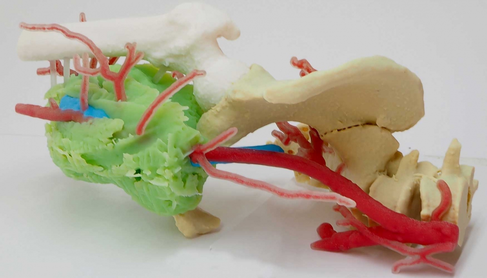 Biomodelo fsico impreso en 3D de una lesin de estirpe grasa en el compartimento anterior del muslo derecho