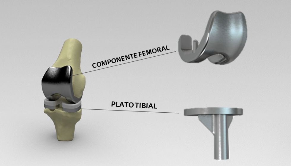 Figura 1: Componentes femoral y tibial de una prtesis de rodilla