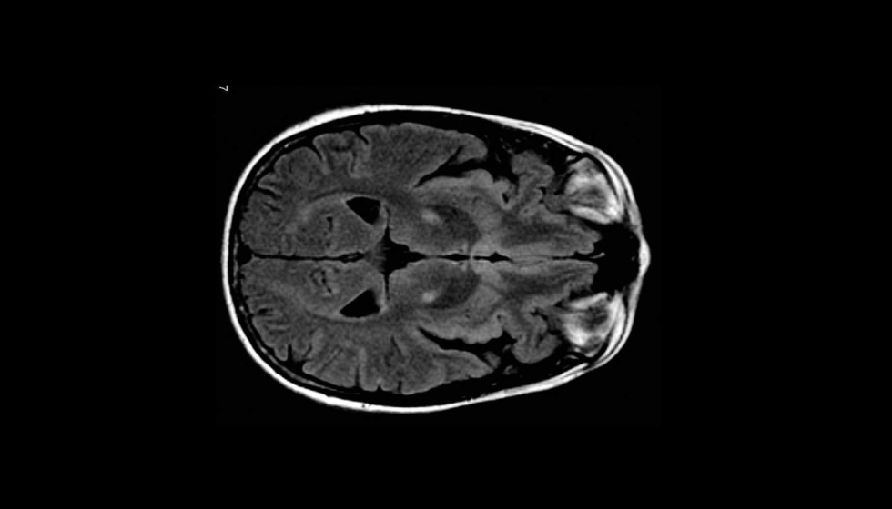 La esclerosis lateral amiotrfica (ELA) es una enfermedad degenerativa caracterizada por la prdida progresiva de neuronas motoras superiores e...