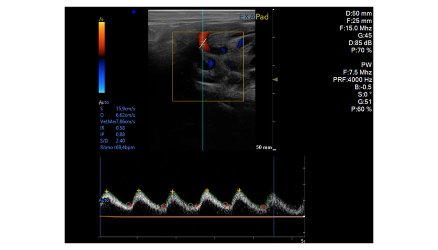 Figura 7. Imagen ecogr�fica en modo Doppler color y pulsado en la que se observa y se cuantifica el flujo sangu�neo de la arteria testicular...