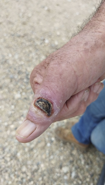 �ntrax en dedo pulgar