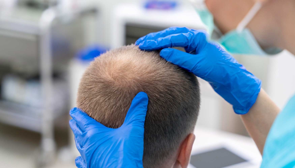 Foto de Los tratamientos láser aumentan un 55% convirtiéndose en la opción más demandada para frenar la caída del pelo