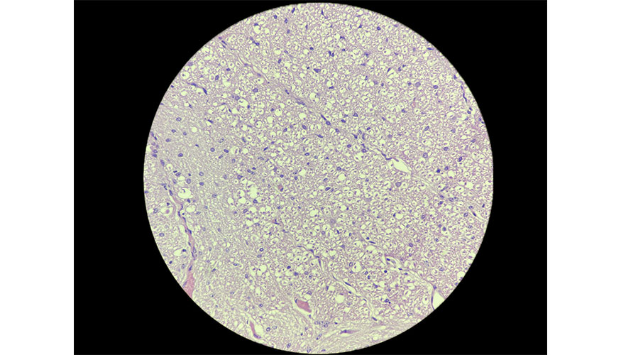 Figura 7. Muestras histopatol�gicas de enc�falo con depleci�n de la sustancia blanca con tinci�n H-E, observadas a 100 aumentos. a...