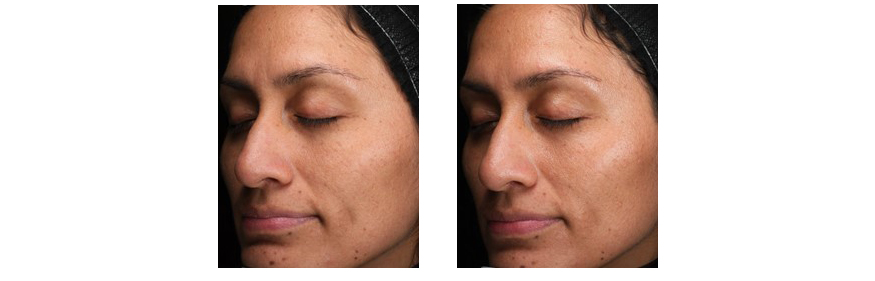 Antes y despus de 24 horas de aplicar la cremaTotal Moisture Daily Facial Cream