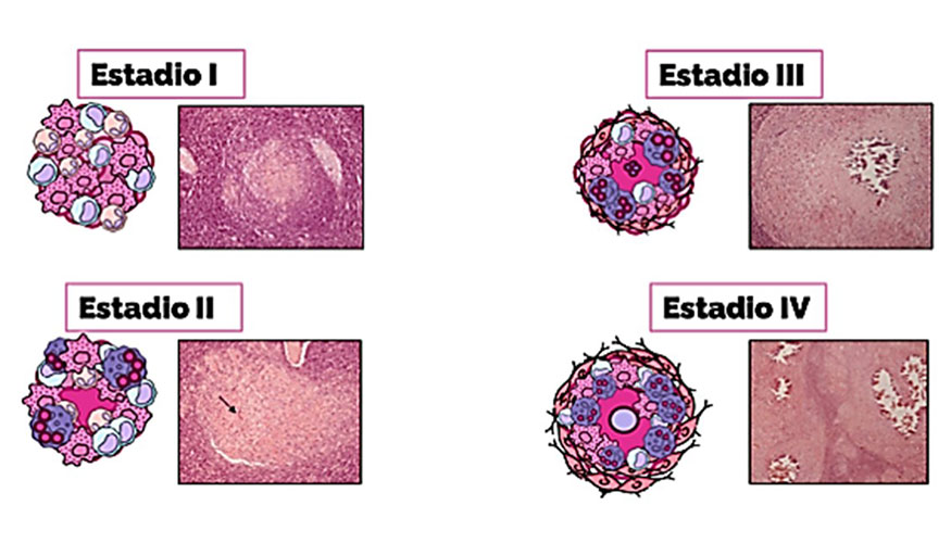Figura 1. Representaci�n esquem�tica y fotograf�a (Wangoo et al., 2005) de las diferentes poblaciones celulares en cada estadio de granuloma...