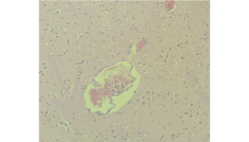 Figura 3. Secci�n histopatol�gica del enc�falo. Edema perivascular con dilataci�n de los espacios de Virchow-Robin. H&E, x40...