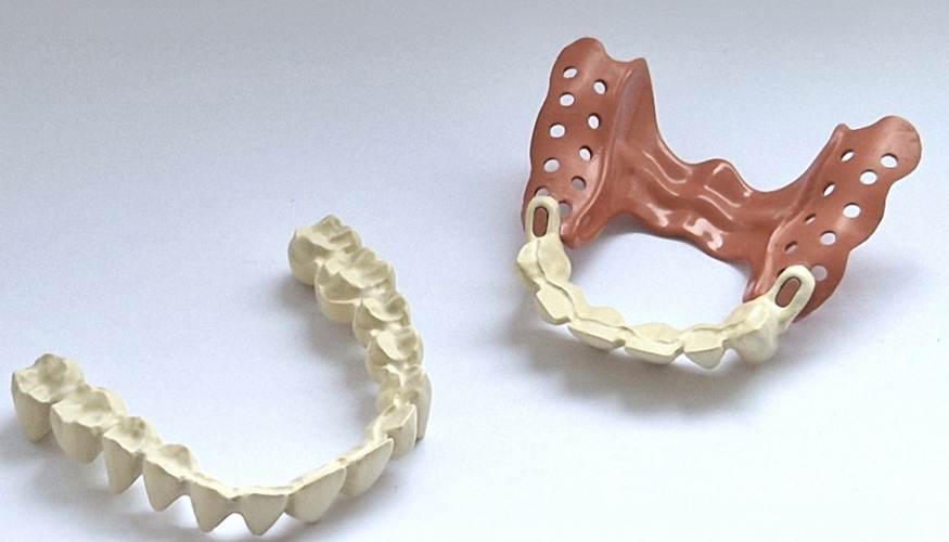 Vestakeep DC4760, en color dentina, y DC4780, en color gingival...