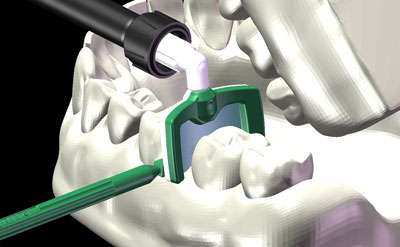 Las cuas de plstico ofrecen al dentista espacio suficiente entre dientes para completar el tratamiento